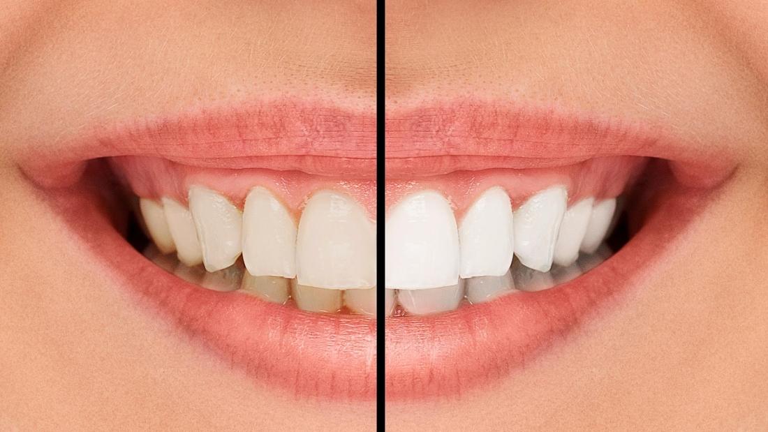 Best teeth whitening in los angeles