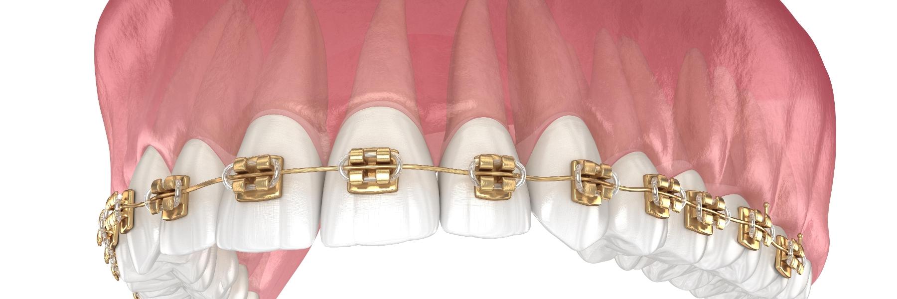 Gold Braces | Dentist