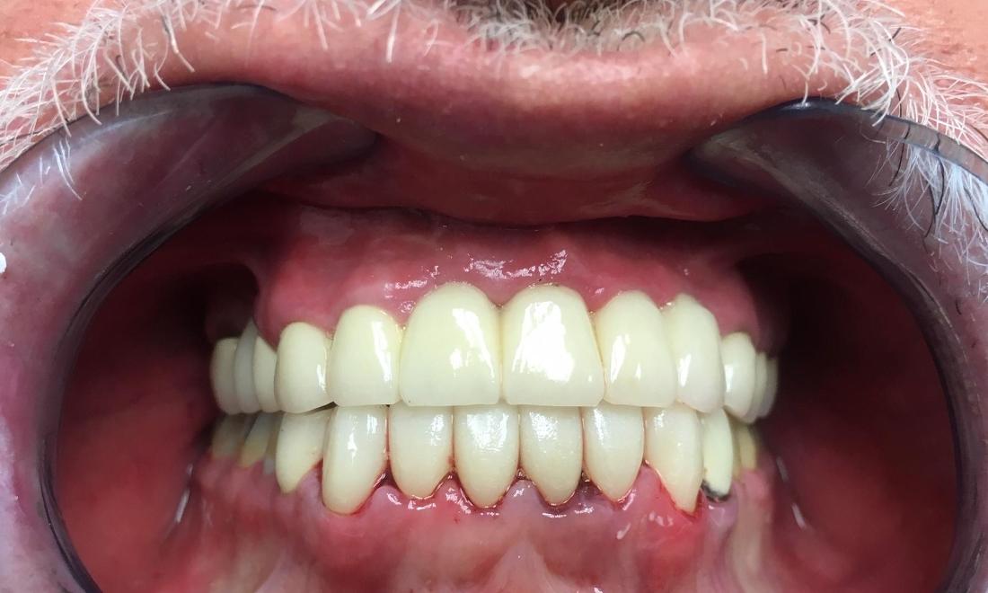 Dental Crowns in Pico Rivera Dental Crowns Improve Smile