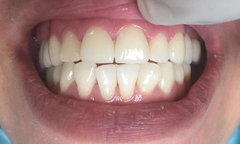 Dental Crown Results | LA Cosmetic Dentist