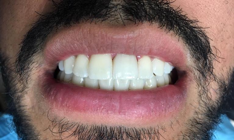 Dental Crows to Whiten Teeth | Inglewood CA