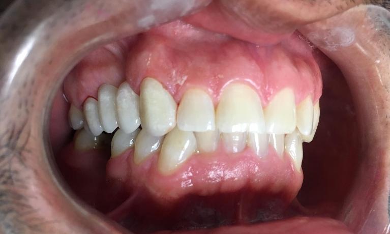 Dental Bridges After Photo in Los Angeles