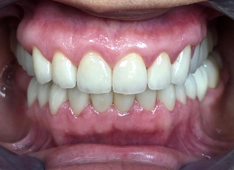 All-White-Crowns-After-Image
