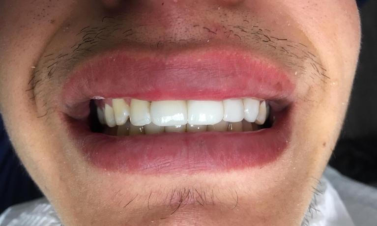 Fixed Bridge to Replace Missing Teeth | Lynwood CA