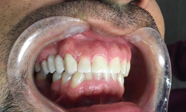 Dental Bridge Tooth Replacement in Los Angeles