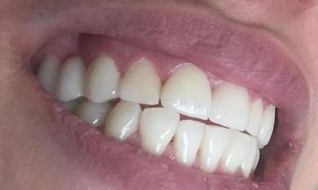 Patient with Dental Crowns | Dentist LA