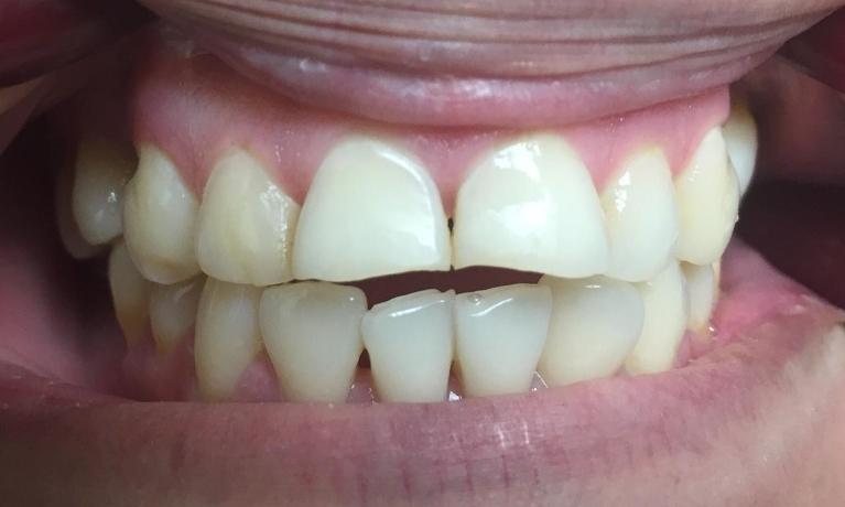 Patient Before Dental Crowns | Los Angeles Dentist