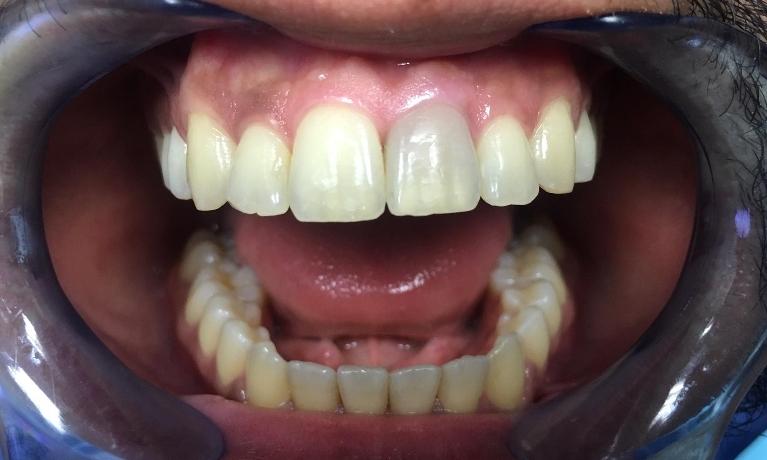 Patient with Discoloration | Teeth Whitening in Inglewood CA