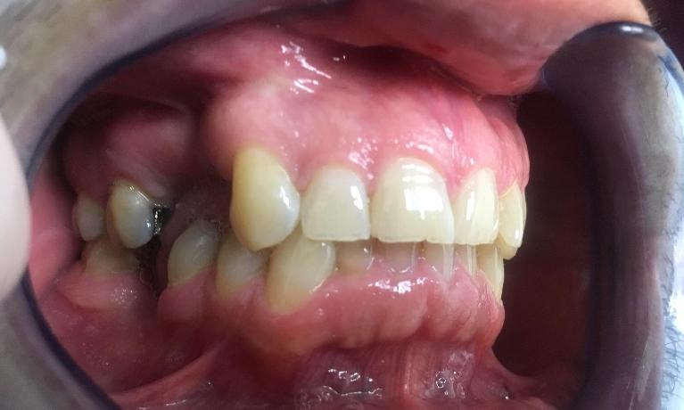 Missing Tooth | Dental Bridges LA