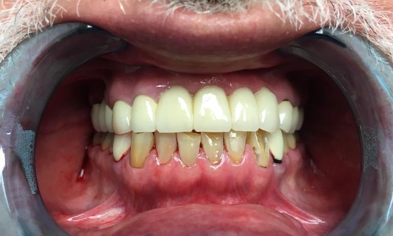 Dental Crowns Before and After Photo | Pico Rivera Dentist