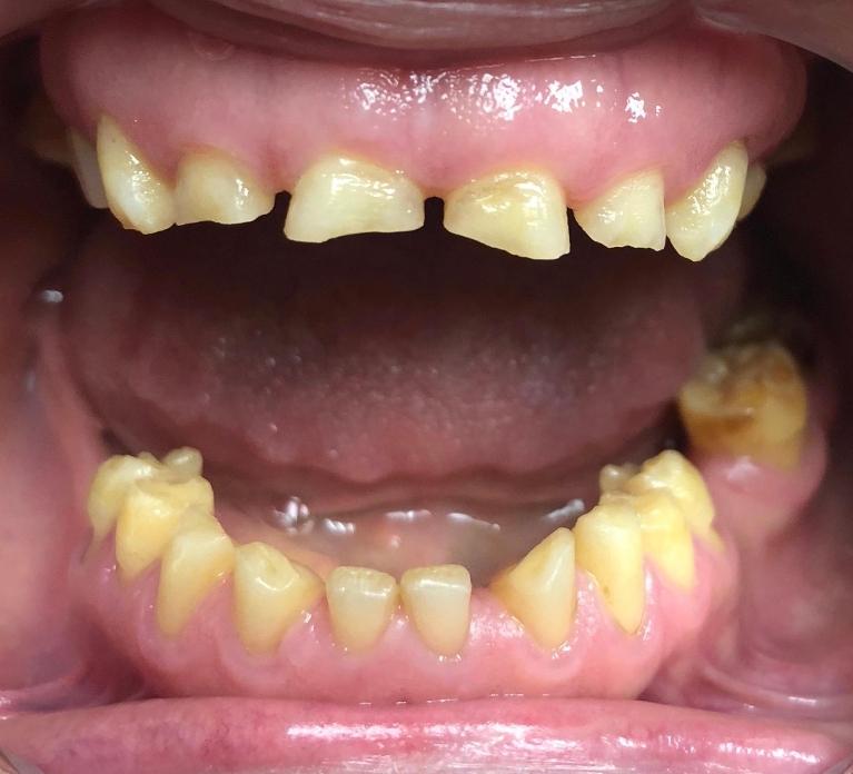 All-White-Crowns-Before-Image