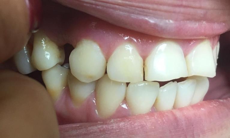Dental Crown Before | LA Dentist