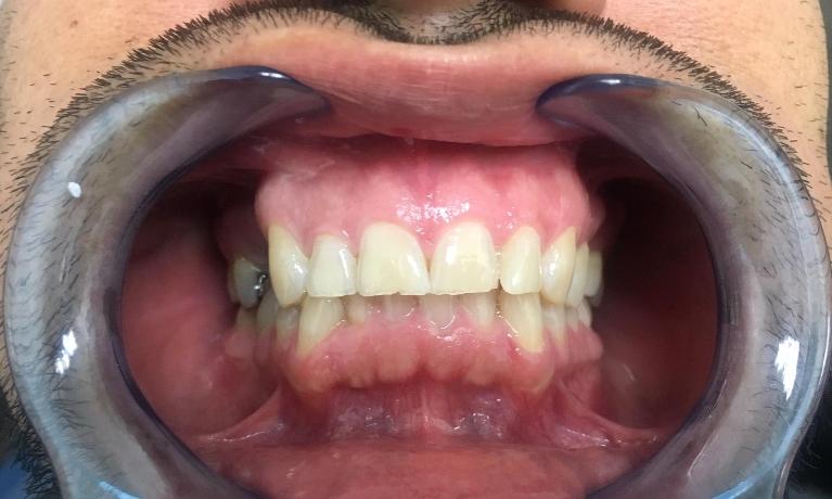 Patient with Missing Tooth | Los Angeles Bridges