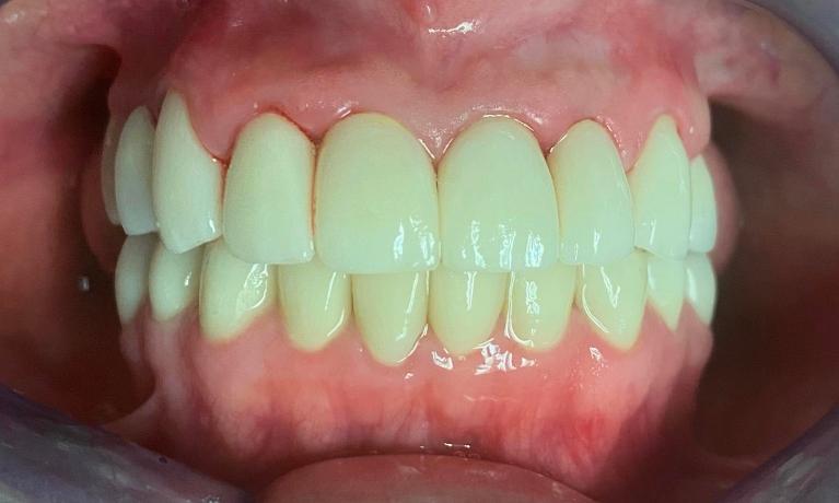 Full-Mouth-Zirconia-Crown-and-Bridge-Work-in-Lynwood-After-Image