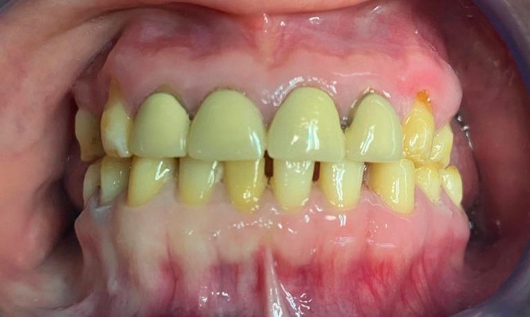 Full-Mouth-Zirconia-Crown-and-Bridge-Work-in-Lynwood-Before-Image